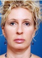 Brow lift