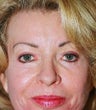 Forehead Lift (browlift)