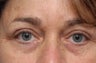 Browlift