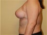 Breast Lift