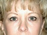 Brow Lift