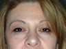 Brow Lift 