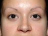 Brow Lift