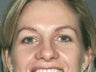 Brow Lift