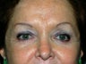 Brow Lift