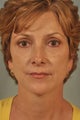 Brow Lift and Lower Lid Hetter Peel Surgery Patient