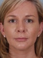Brow Lift