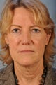 Brightening up her eyes with a brow lift and upper and lower Blepharoplasty.