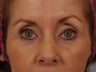 Brow Lift and Upper Blepharoplasty