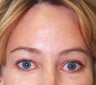 Before and After Endobrow in Female