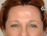 Endoscopic Brow Lift
