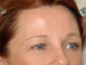 Endoscopic Brow Lift