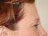Endoscopic Brow Lift