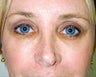 Endoscopic Brow Lift