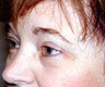 browlift and upper eyelid surgery