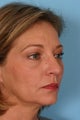Brow Lift, Blepharoplasty, and Fat Transfer