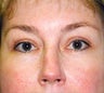 Endoscopic Brow Lift and Blepharoplasty