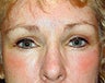 Brow Lift and Chemical Peel