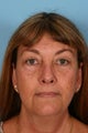 Browlift, Blepharoplasty and Otoplasty