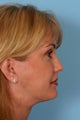 Browlift, Blepharoplasty, Lower Facelift