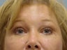 Face Lift, Brow Lift and Blepharoplasty