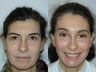 Full Facelift - Browlift, upper and  lower blepharoplasty, Lower Facelift