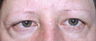 Brow Lift with lower blepharoplasty (lower eyelids)