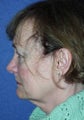 Brow Lift