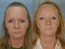 Endoscopic Browlift and Laser Resurfacing to lower eyelids