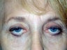 Upper Eyelid Ptosis Repair And Blepharoplasty; Lower Eyelid Blepharoplasty And Ectropion Repair; Endoscopic Brow Lift