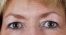 Brow Lift