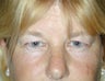 Endoscopic Brow Lift and Blepharoplasty