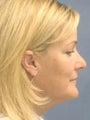 Endoscopic browlift, Upper and Lower Blepharoplasty, Liposuction of the Neck, Fat injections to the lips, Perioral Dermabrasion.