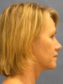  Endoscopic Browlift, Lower Blepharoplasty, Fat Injections to the Lips and Nasolabial Folds, Perioral Dermabrasion, and removal 