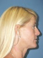  Coronal Browlift, Upper and Lower Blepharoplasty, Llp Augmentation with Alloderm® graft, Perioral Dermabrasion.  