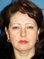  Endoscopic Browlift, Upper and Lower Blepharoplasty 