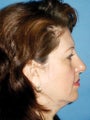  Endoscopic Browlift, Upper and Lower Blepharoplasty 