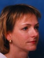  Endoscopic Browlift, Upper and Lower Blepharoplasty, Rhinoplasty with refinement of the nasal tip and dorsum. 