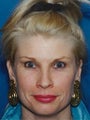 Endoscopic Browlift