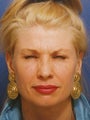  Endoscopic Browlift 