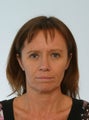Browlift Blepharoplasty Chin Augmentation Botox  Juvederm