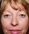 Forehead Lift (browlift)