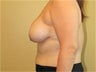 Breast Lift