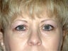 Brow Lift