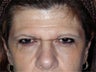 Brow Lift 
