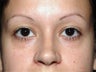 Brow Lift