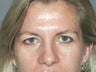 Brow Lift