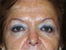 Brow Lift