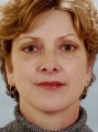 Brow Lift and Lower Lid Hetter Peel Surgery Patient