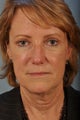 Brightening up her eyes with a brow lift and upper and lower Blepharoplasty.